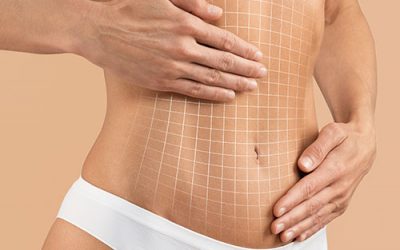 Abdominoplastia en Valladolid: guía completa antes de tu cirugía abdominal