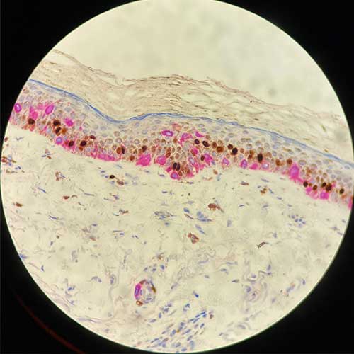 Inmunohistoquímica. Anatomía patológica. LoMás, Dermatología y Medicina Estética Integral. Recoletas Salud