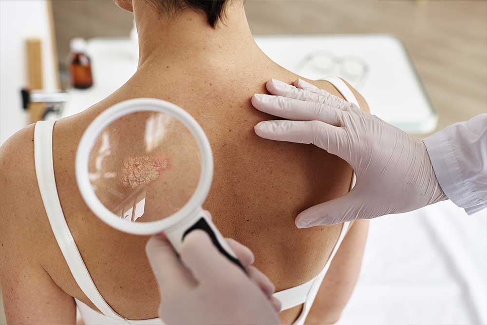Cáncer cutáneo. Dermatología . Lomás