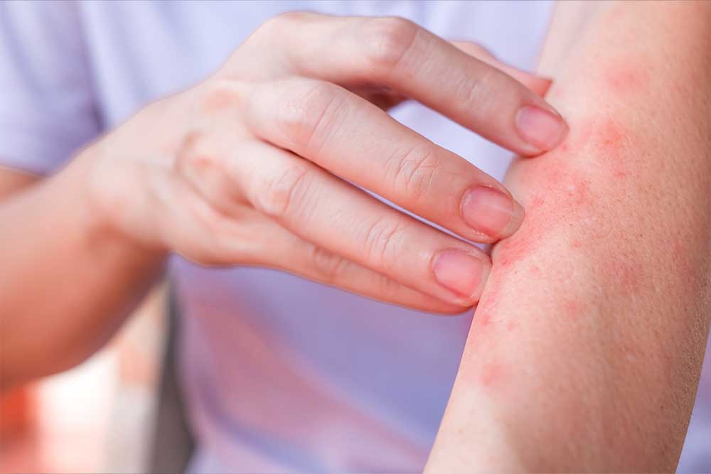 Dermatitis atópica. Dermatología . Lomás