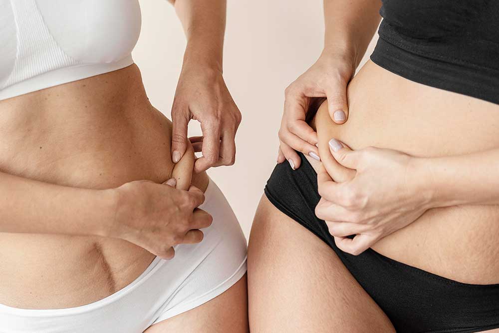 Adiposidad localizada y celulitis. Medicina Estética Corporal