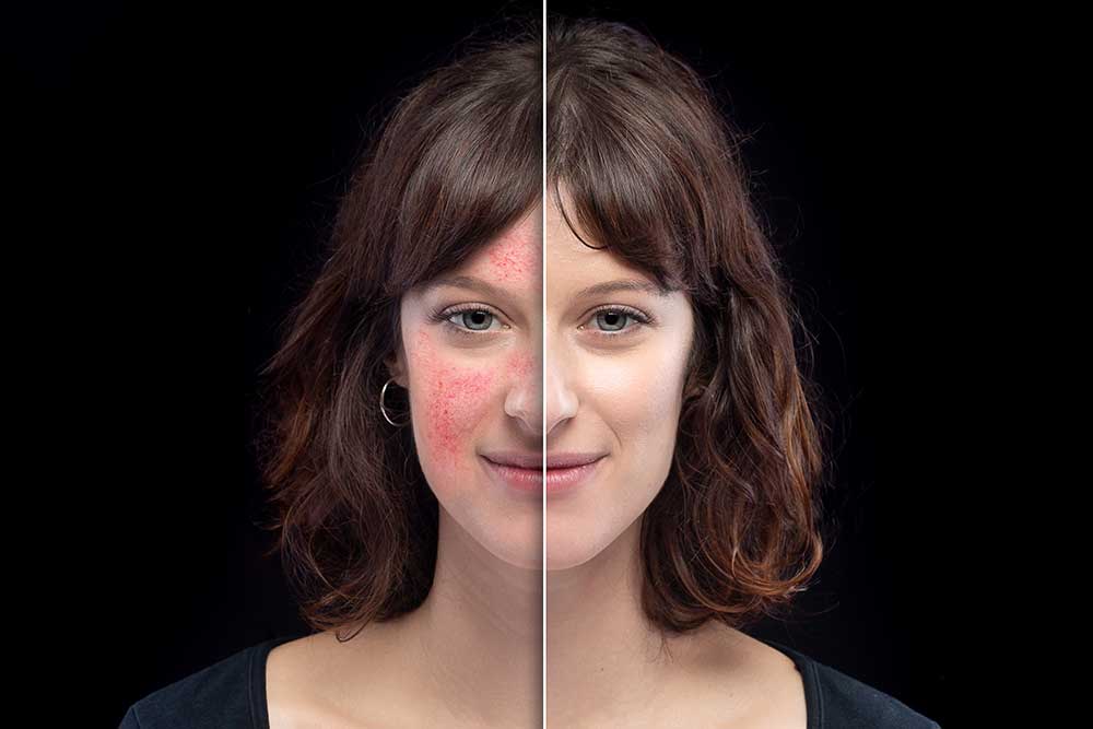 Rosacea. Dermatología. Lomás