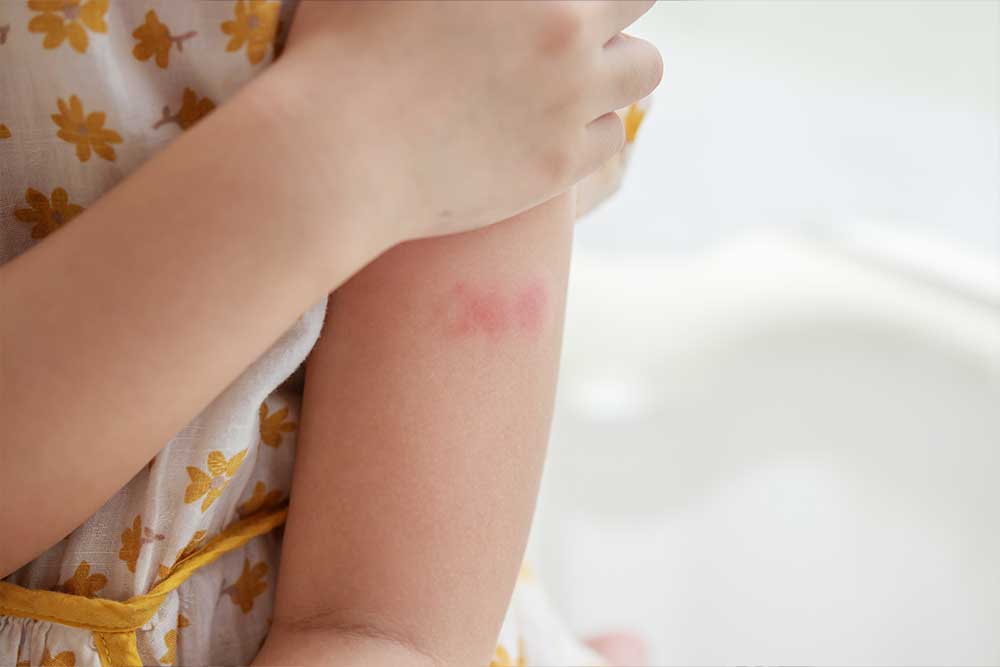 Urticaria y prurito. Dermatología. Lomás
