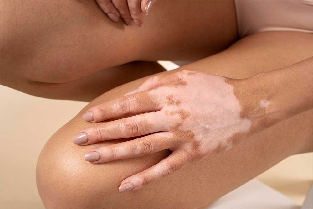 Vitíligo. Dermatología. Lomás