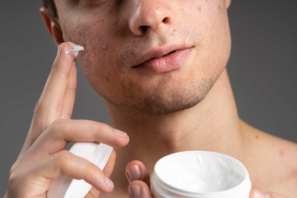Acné. Dermatología . Lomás