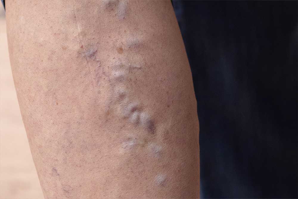 Escleroterapia. Cirugía Vascular. Lomas
