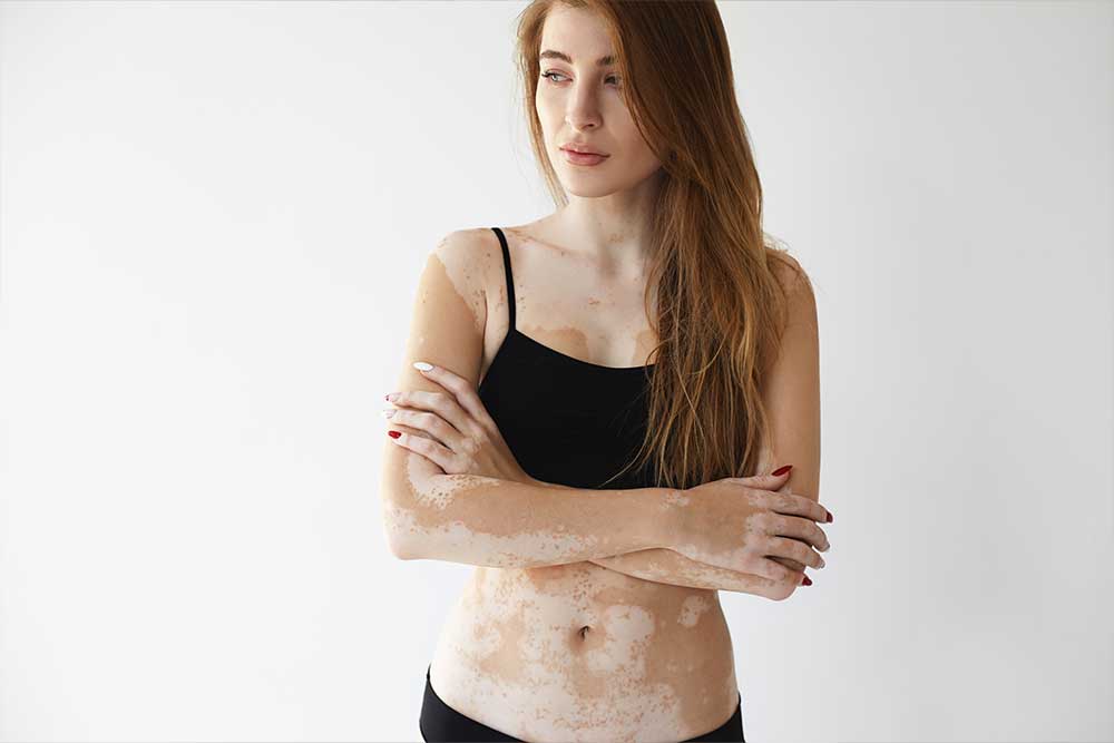 Vitíligo. Dermatología. Lomás