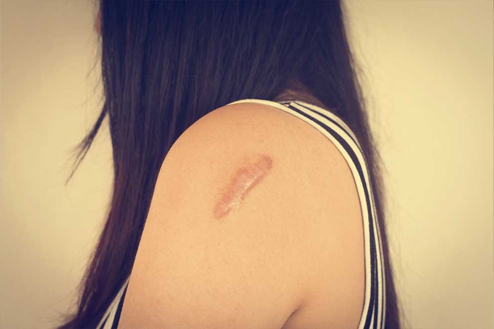 Tratamiento de cicatrices. Dermatología. Lomás