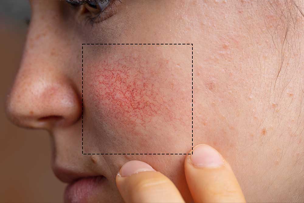 Rosacea. Dermatología. Lomás