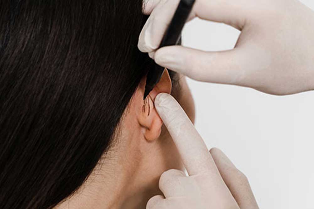 Otoplastia. Cirugía plástica facial Otoplastia. Cirugía plástica facial