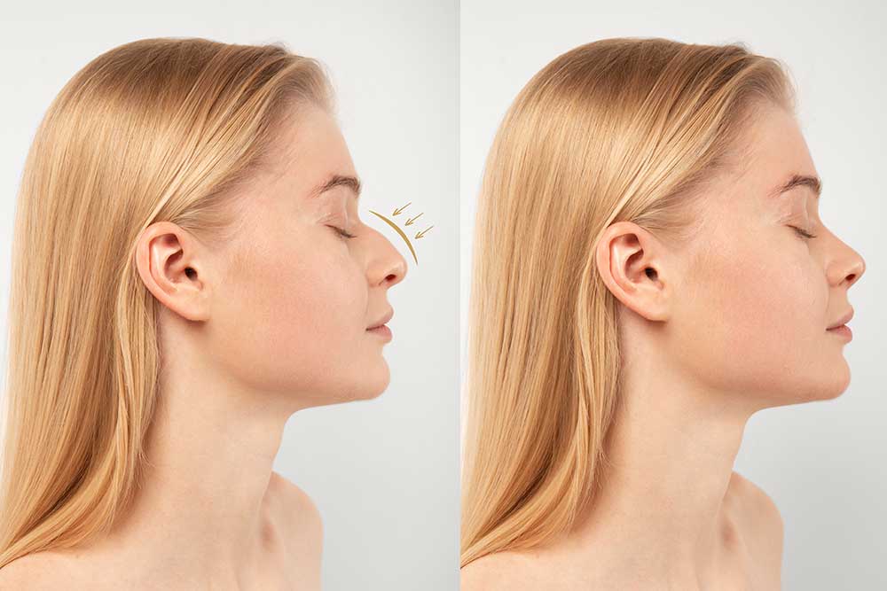Rinoplastia. Cirugía plástica facial